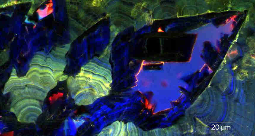 肾结石生长并溶解像地质晶体