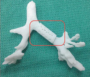3D印刷气道夹板可节省宝贝的生命
