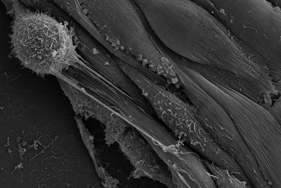 新研究揭示了癌细胞如何逃离血管