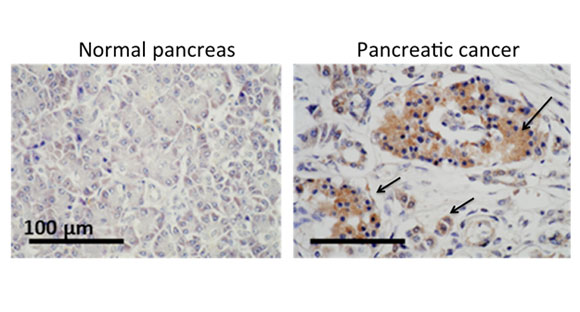 耶鲁研究表明，胰腺癌生长中的关键蛋白也可能是它的毁灭