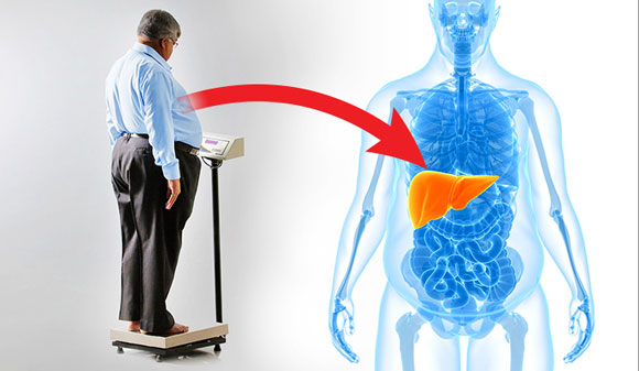 耶鲁大学研究人员确定肥胖与脂肪肝疾病之间的分子联系