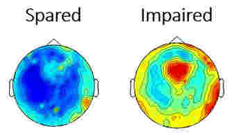 在缺乏癫痫发作期间，研究表明脑活动的广泛破坏