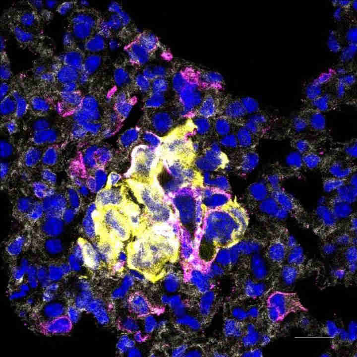 纳米粒子显示治疗乳腺癌的承诺
