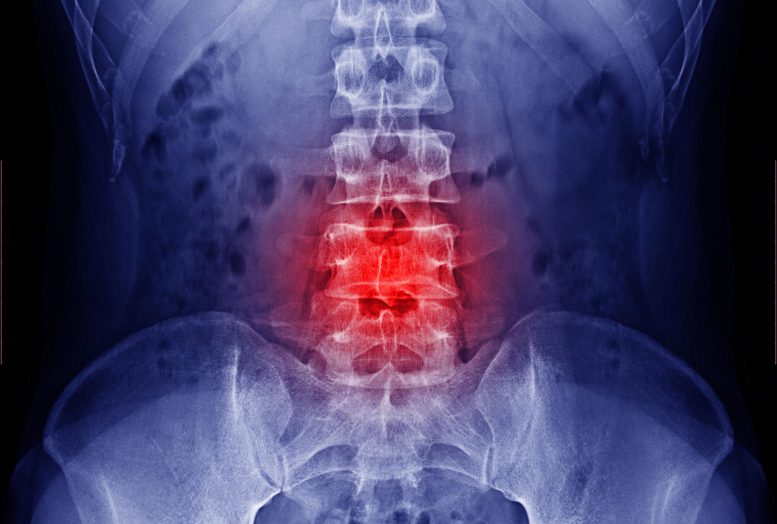 约翰斯·霍普金斯（Johns Hopkins）分析电刺激疗法对脊柱融合的有效性