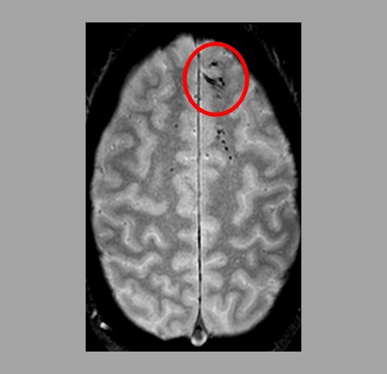 微斑秃 - 在CT扫描上被检测到太小 - 可能会在头部受伤后恶化结果