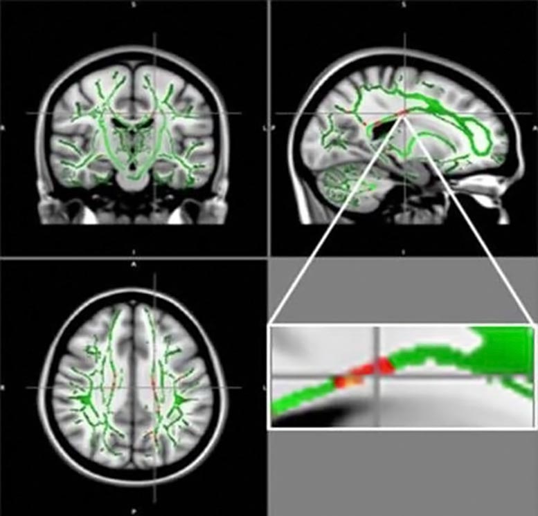 MRI分析揭示了肥胖可能导致青少年的脑损伤