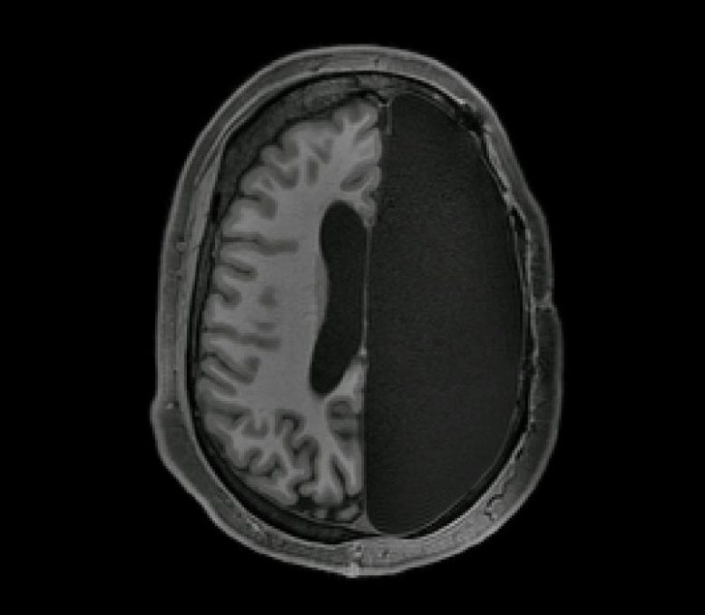 大脑扫描揭示了人脑如何在移除一个半球时如何补偿[视频]