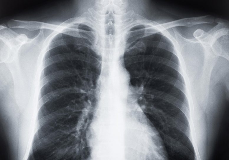 电子烟使用者的肺部疤痕罕见，通常在金属加工工人中发现