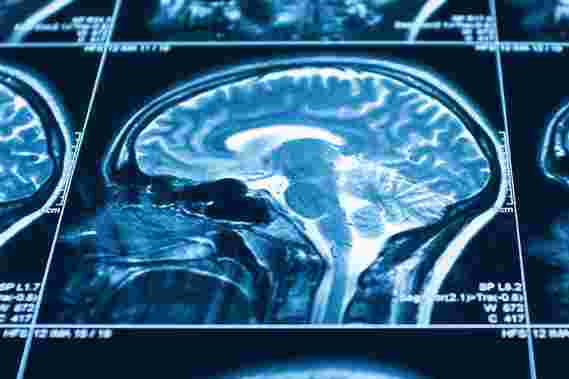 新的研究表明，大脑可能需要熨斗健康认知发展
