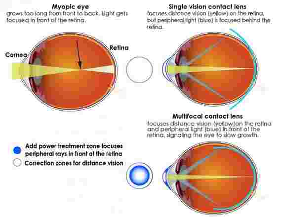 多焦点隐形眼镜在儿童近视的进展缓慢