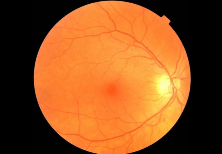 具有强大的人工智能的简单眼科考试可能导致早期帕金森病的疾病诊断