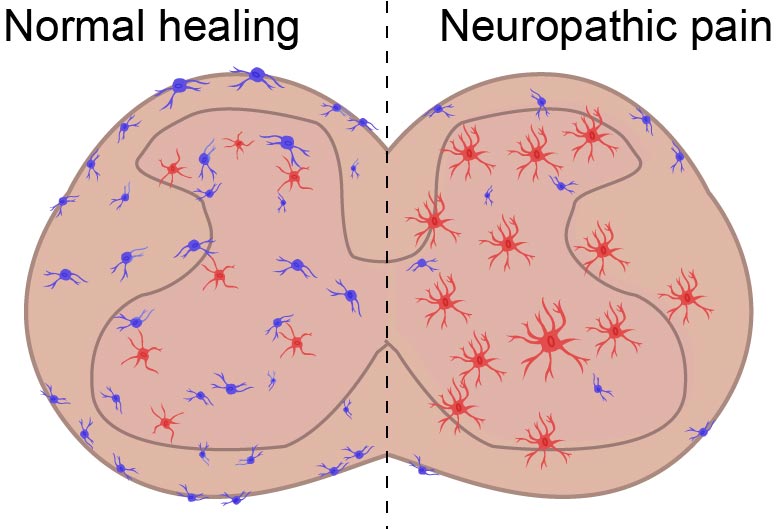 科学家发现新的细胞类型涉及慢性疼痛和炎症 - 精确，新的治疗目标