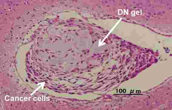 根除癌症：创新的水凝胶可迅速将癌细胞还原为干细胞